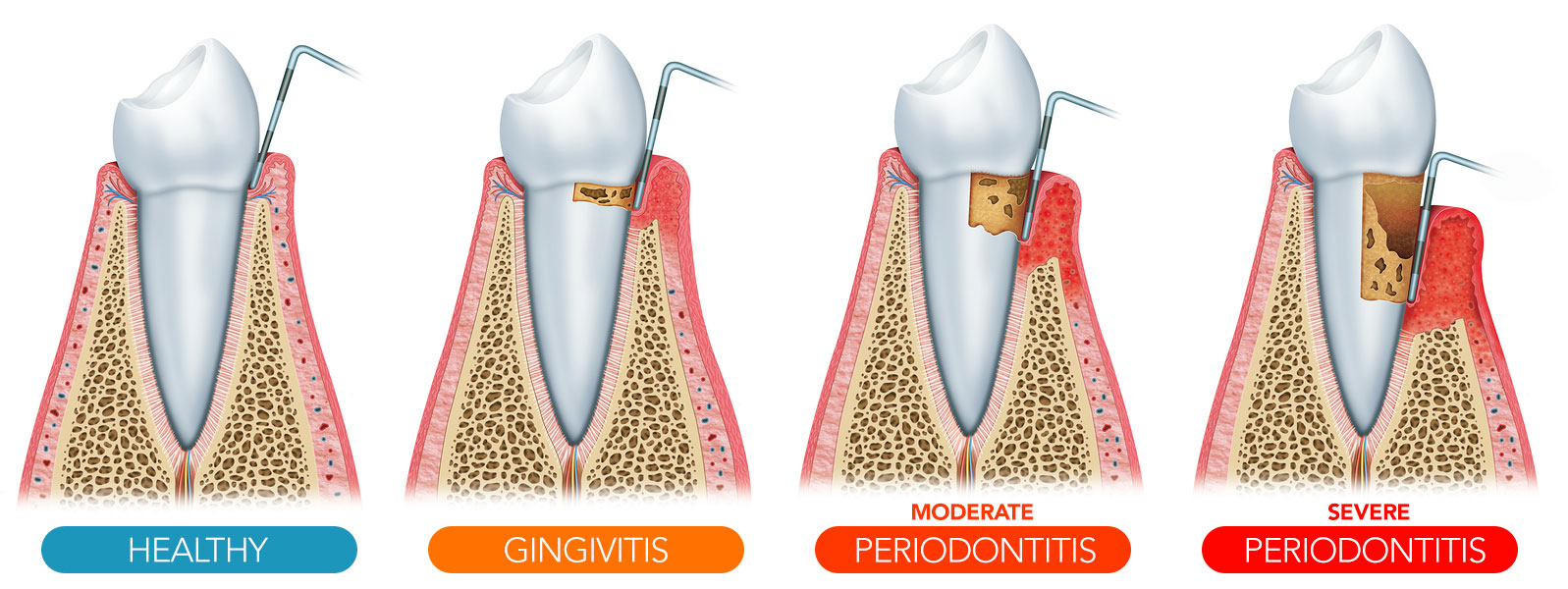 Periodontics Jewett City, CT